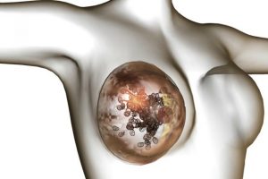 CANCRO AL SENO, CAMBIARE STRATEGIA