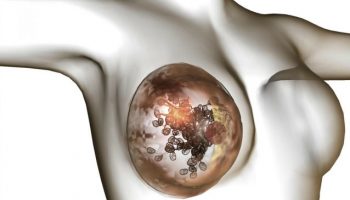 CANCRO AL SENO, CAMBIARE STRATEGIA
